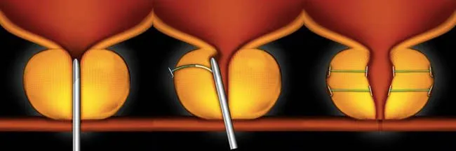 UroLift®