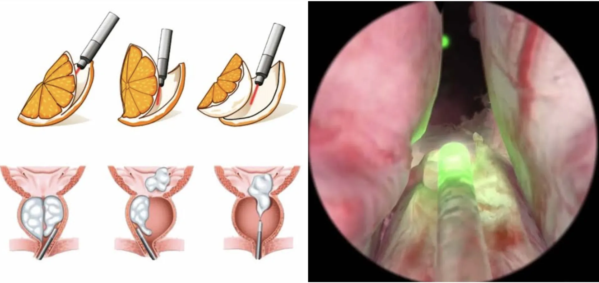 Enucleação Prostática à Laser - HoLEP