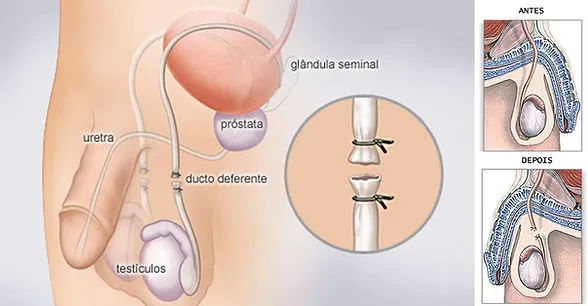 Vasectomia 