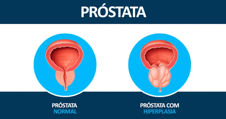 Prostatectomia Simples Robótica (HPB)