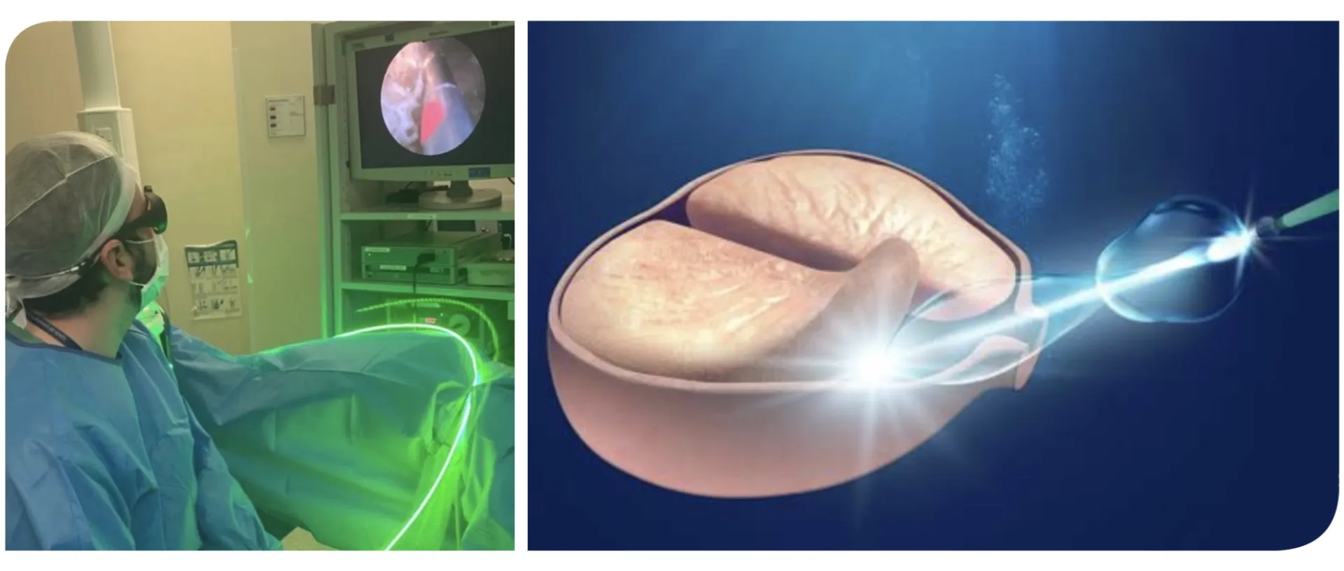 Cirurgias à Laser da Próstata